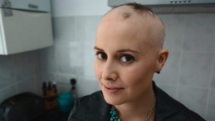 alopecia alopecia