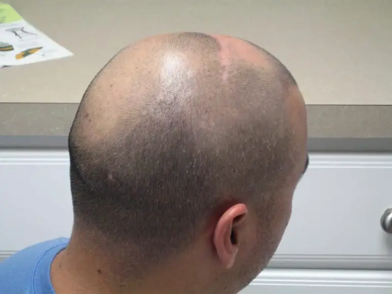 Does masturbation cause hair loss