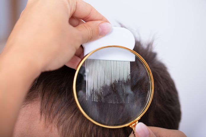 Itchy Scalp After Lice Treatment Itchy Scalp After Lice Treatment