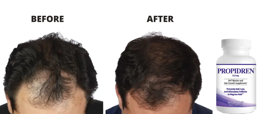 Propidren Reviews: Does it Work for Hair Loss?