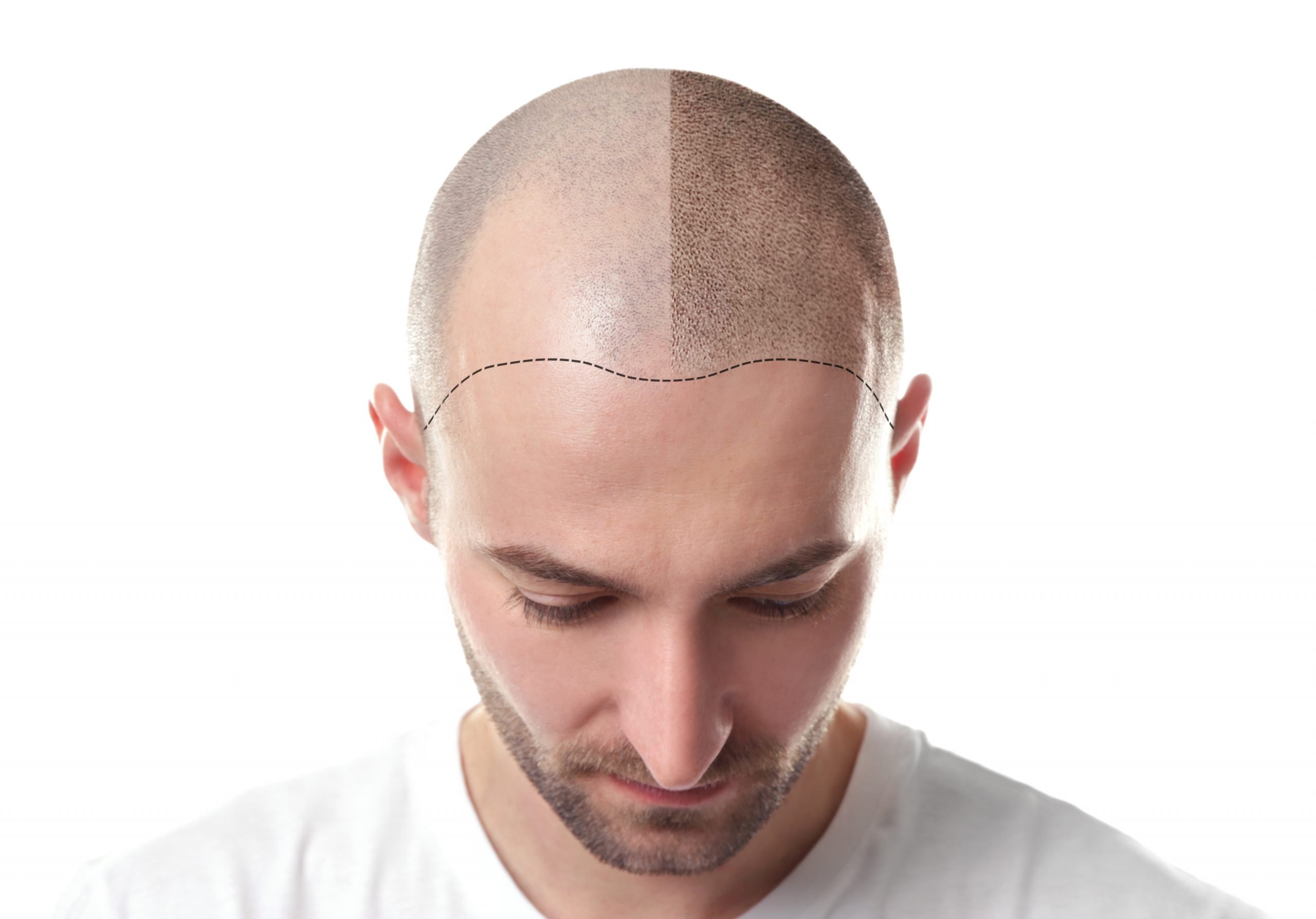 Avodart for Hair Loss: How it Works