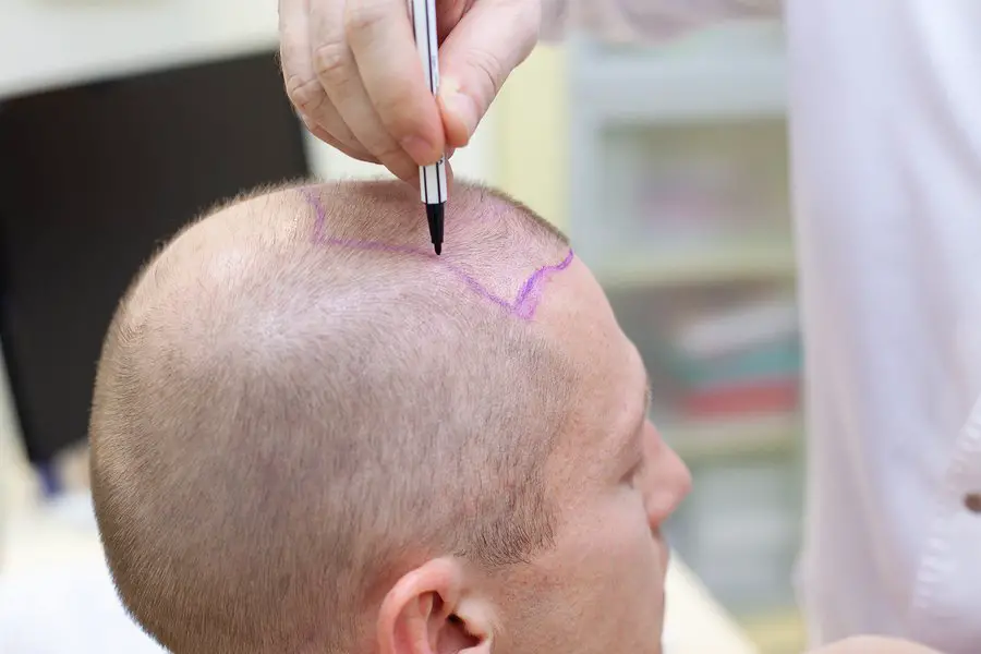 Hair Transplant Post-Surgery Checklist Hair Transplant Post-Surgery Checklist