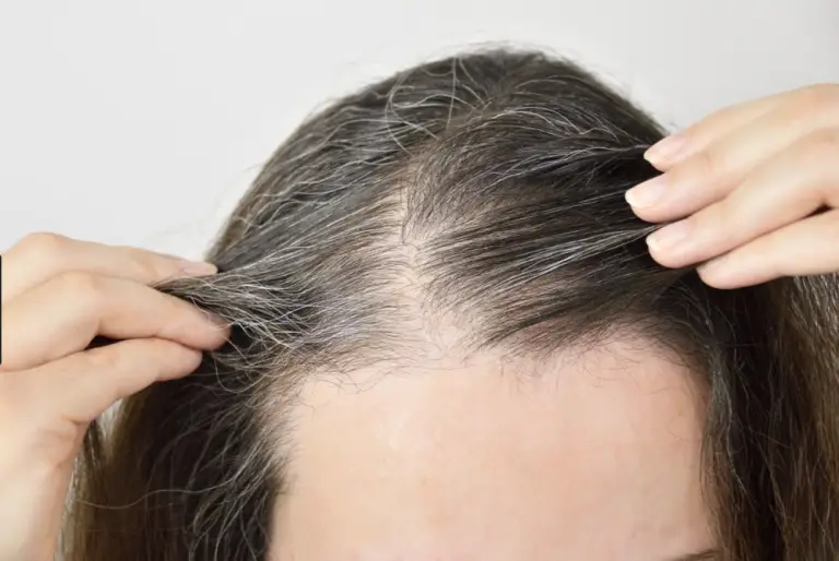 What is Telogen Effluvium and How Should You Treat it? 2022 Hair Loss