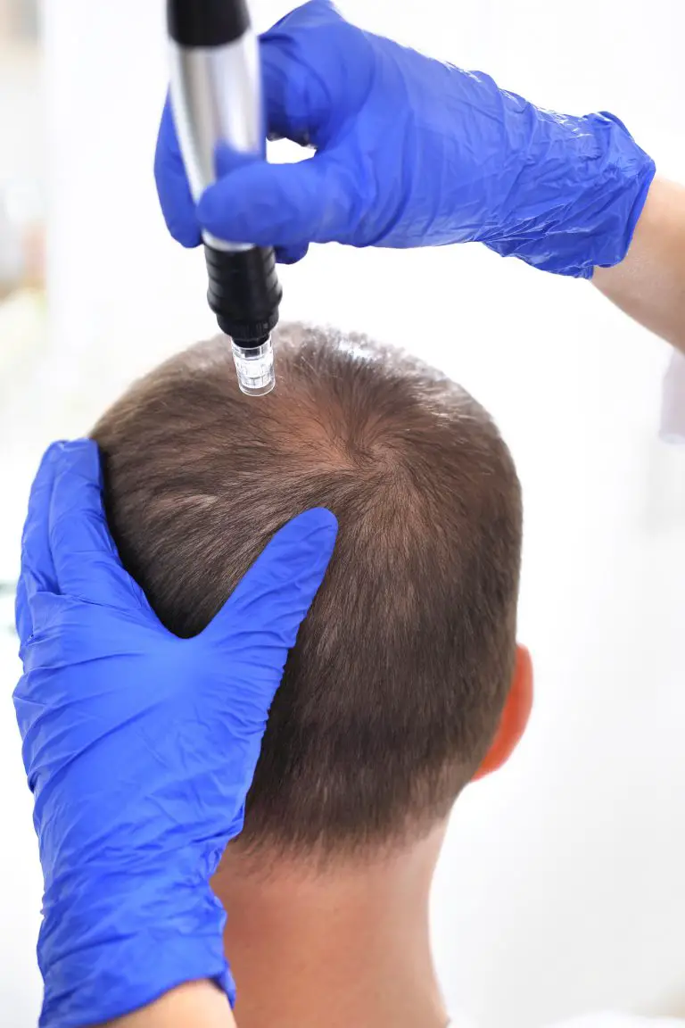 Microneedling for Hair Growth: Does it Work?