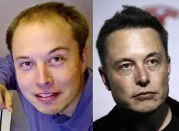Elon Musk Hair Transplant [Before & After]
