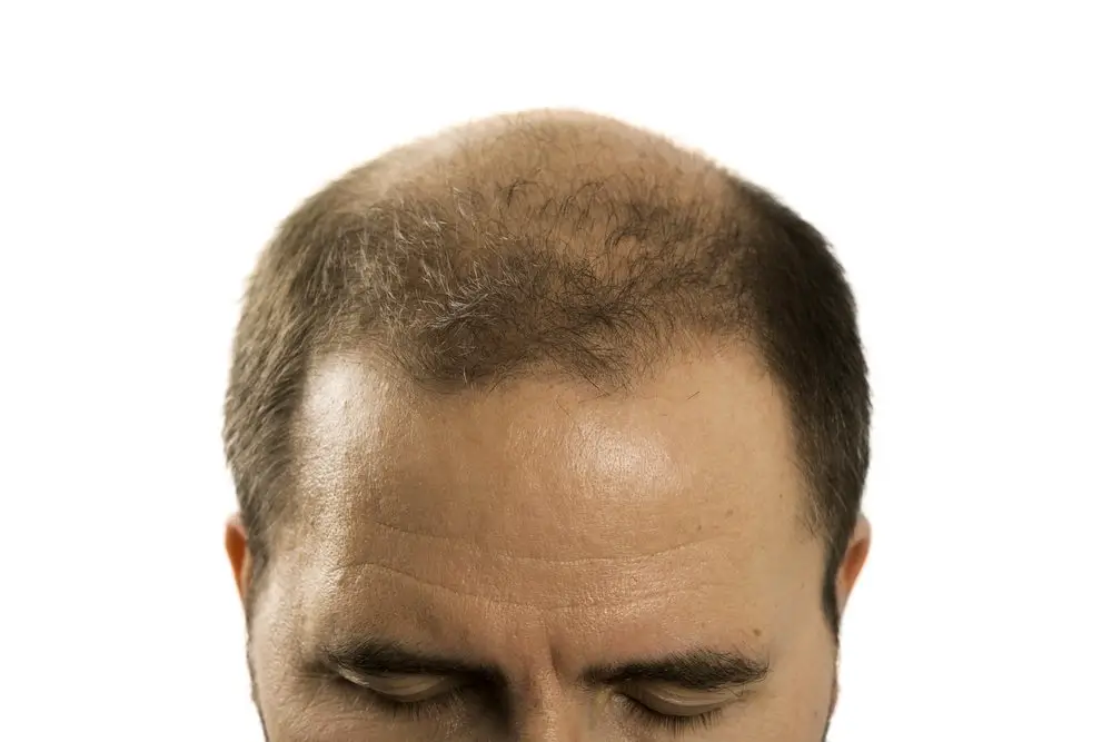 Ruxolitinib for Hair Loss: Worth It?