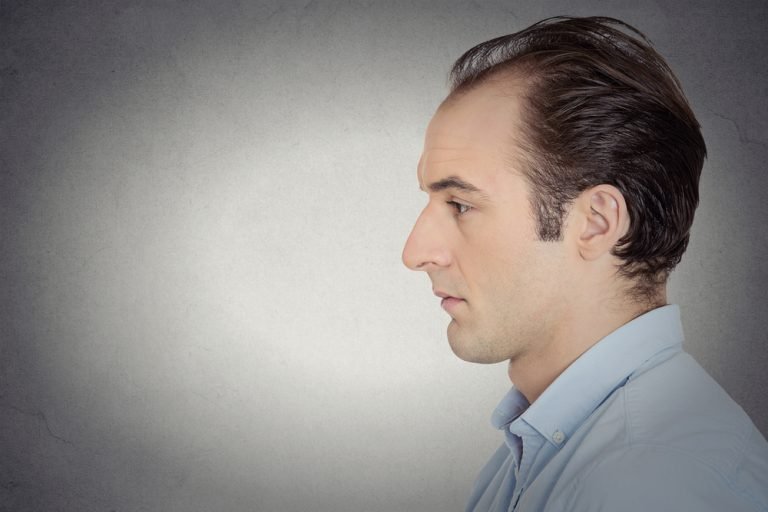 Early Signs of Balding