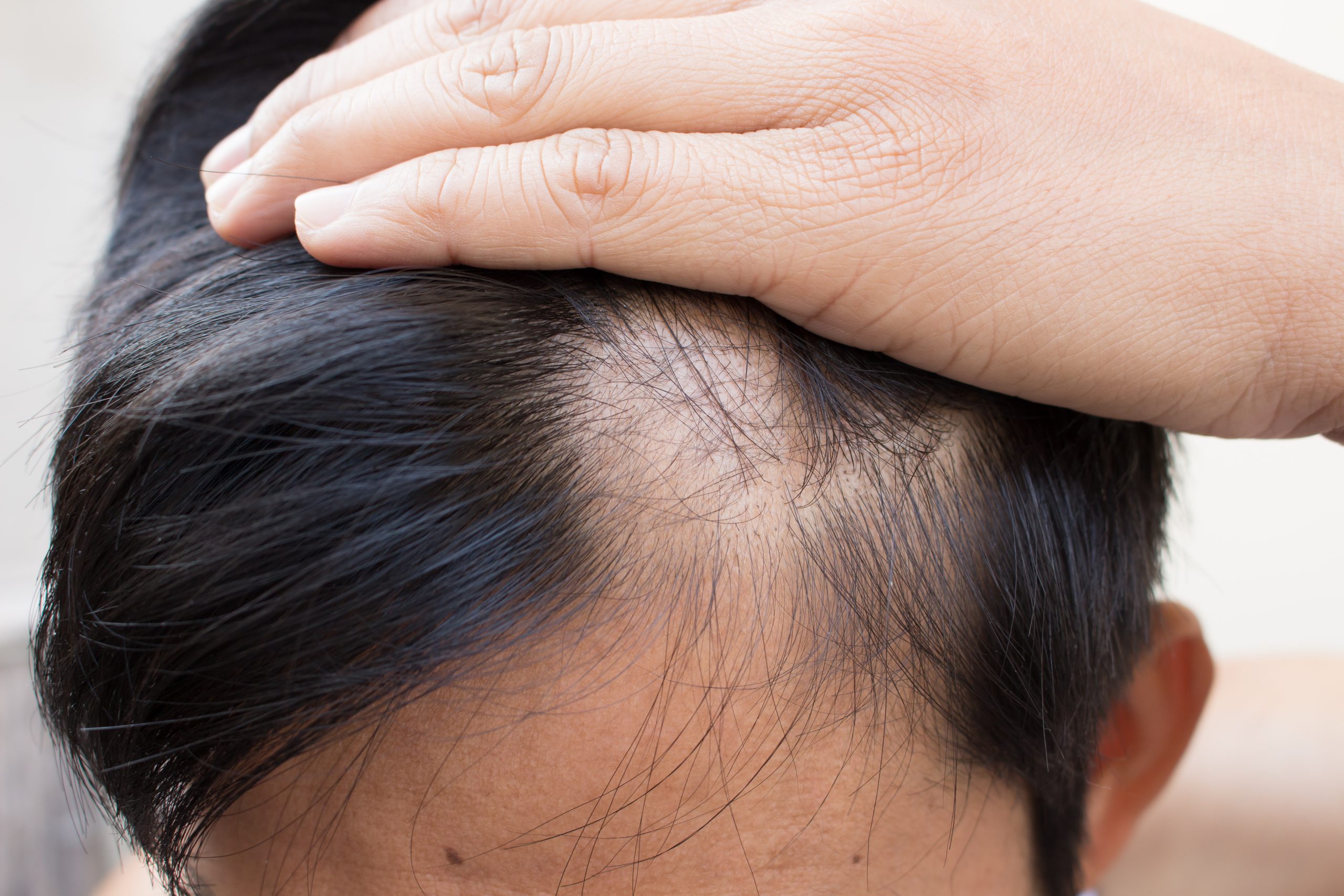Hair loss: Causes, Treatment & Prevention | AROMASE