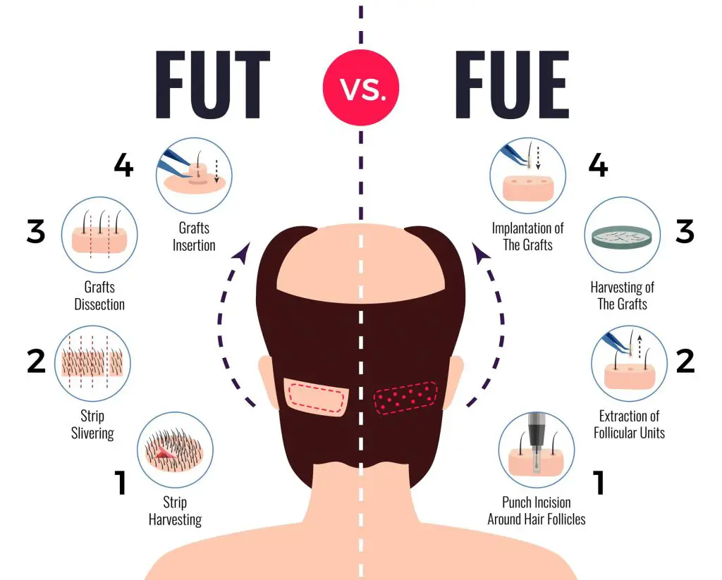 hair transplants turkey fue vs fut