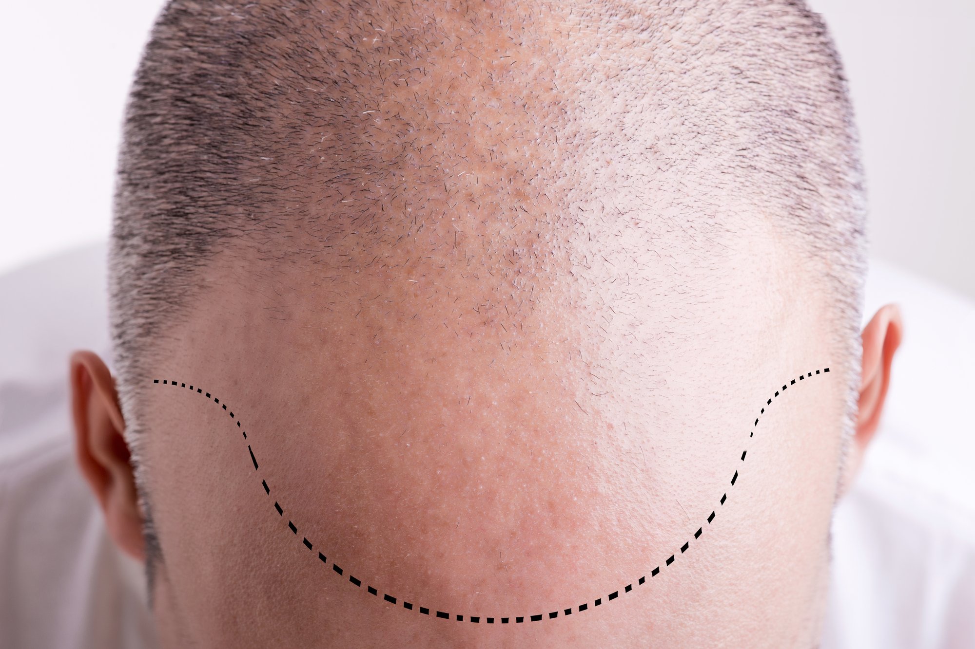 Hair Transplant In Turkey Is Turkey The Place To Go