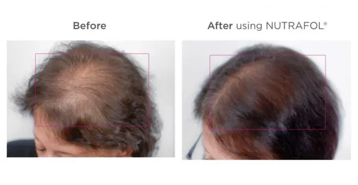 Nutrafol before and after for Hair Loss