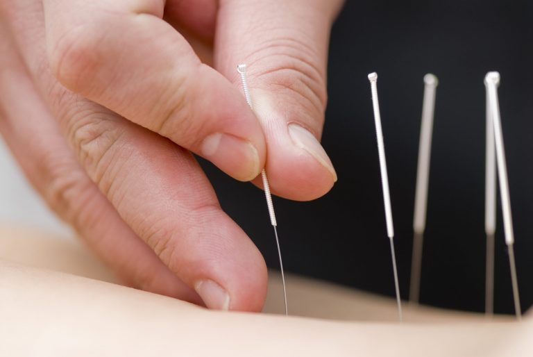 Acupuncture for Hair Growth: Benefits and Results