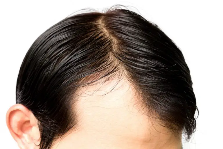 Balding Versus Mature Hairline: What’s the Difference?