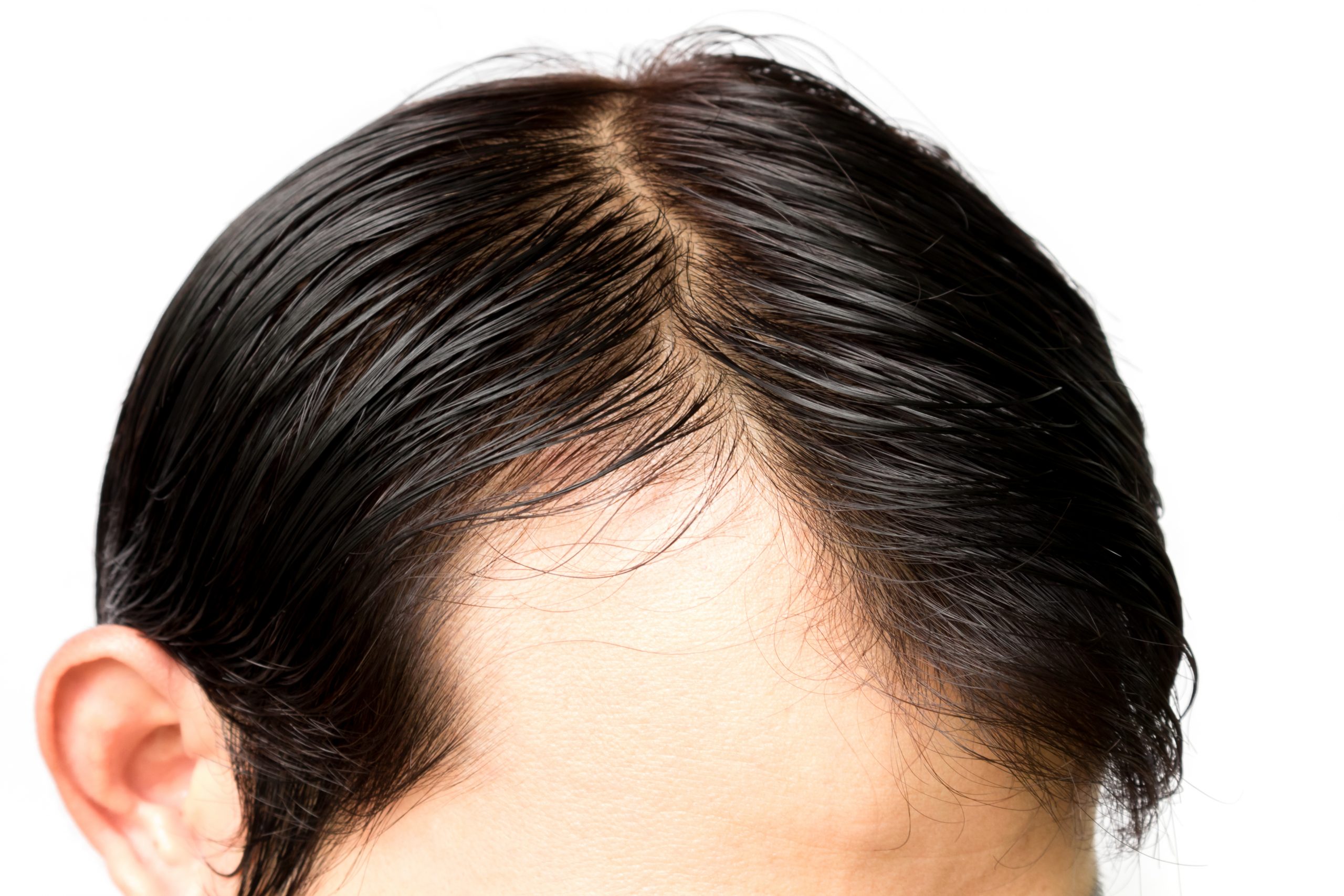 balding-versus-mature-hairline-what-s-the-difference-2021-hair-loss