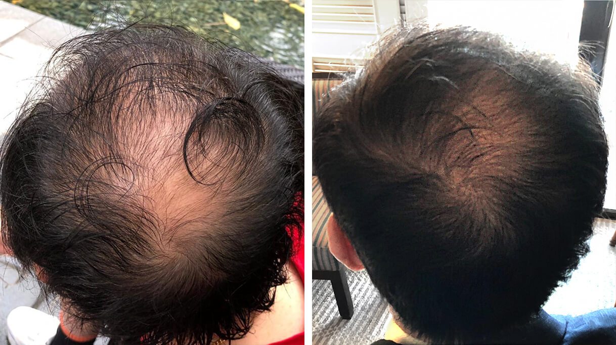 iRestore Laser Hair Growth System Tan Keng Soon Homer Before After 1 640x@2x - iRestore Laser Hair Growth System: Full Review