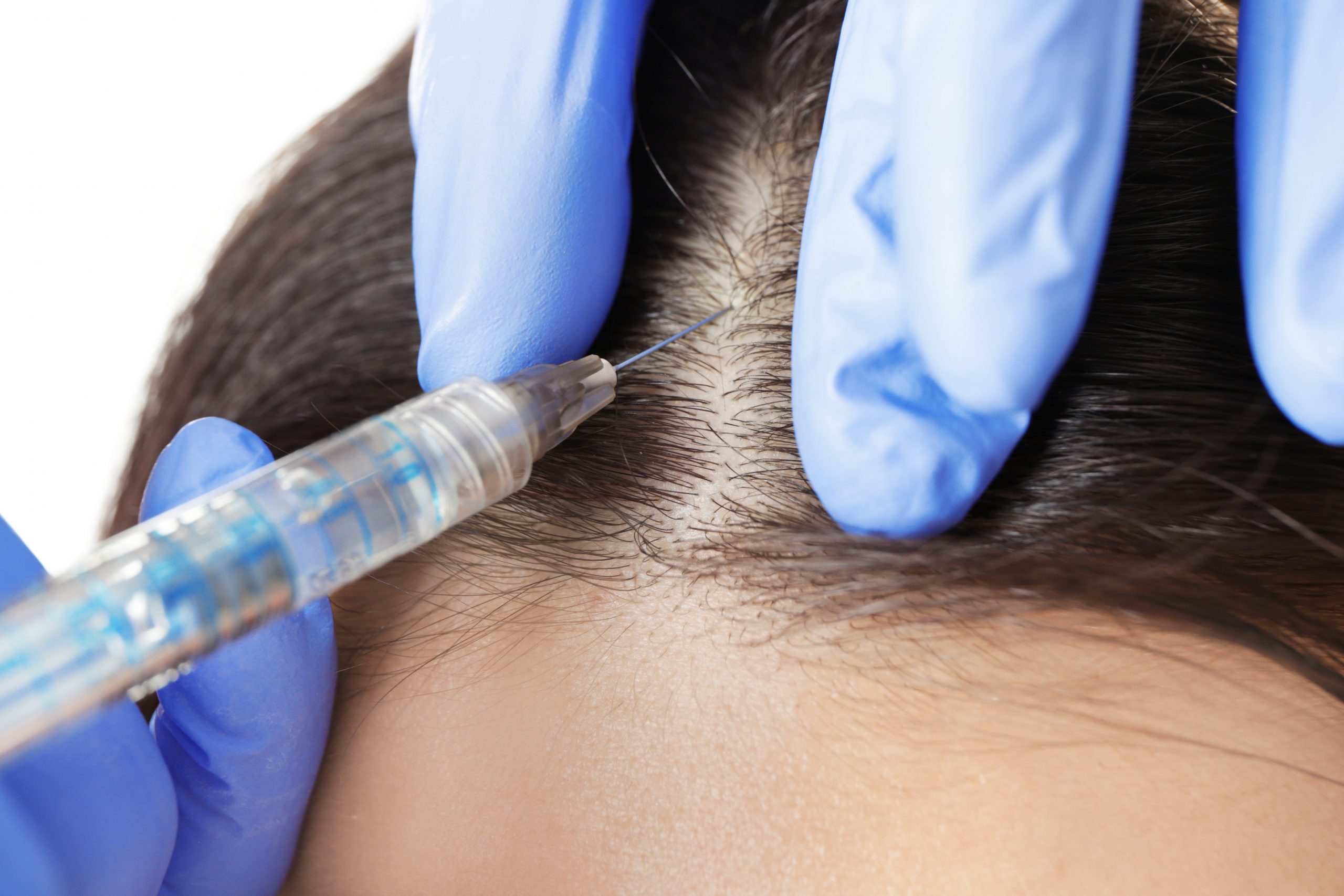 Young woman with hair loss problem receiving injection on white background, closeup
