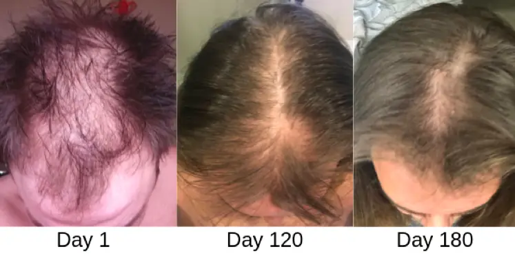 Laser Hair Growth Caps for Thinning Hair