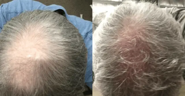 Laser Hair Growth Caps for Thinning Hair