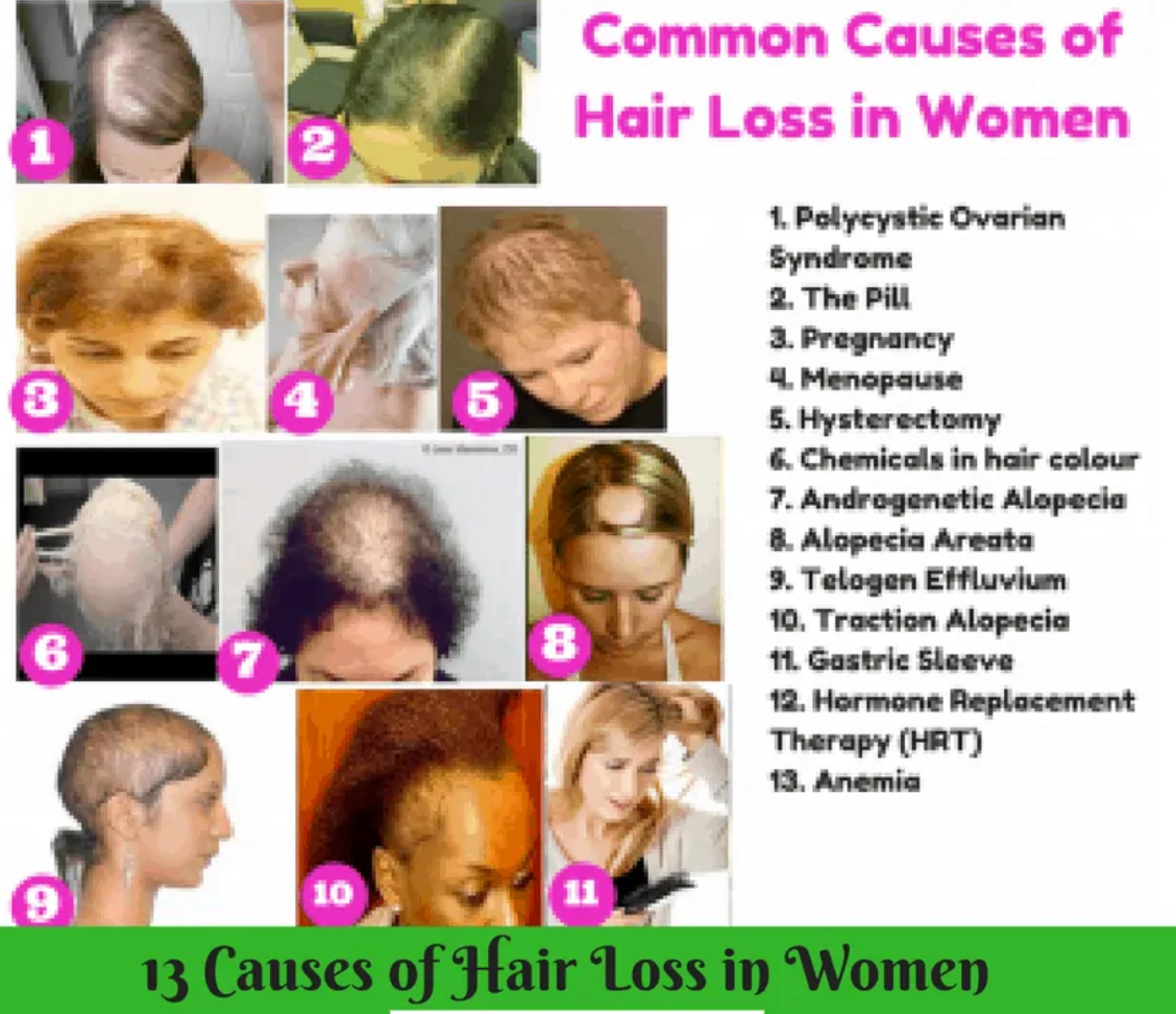 Common Causes of Hair Loss in Women