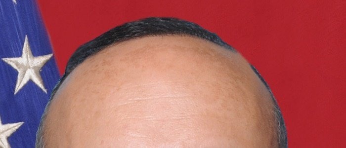 masturbation and hair loss