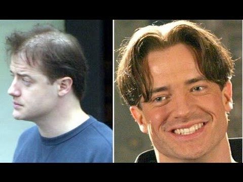 Brendan Fraser hair transplant