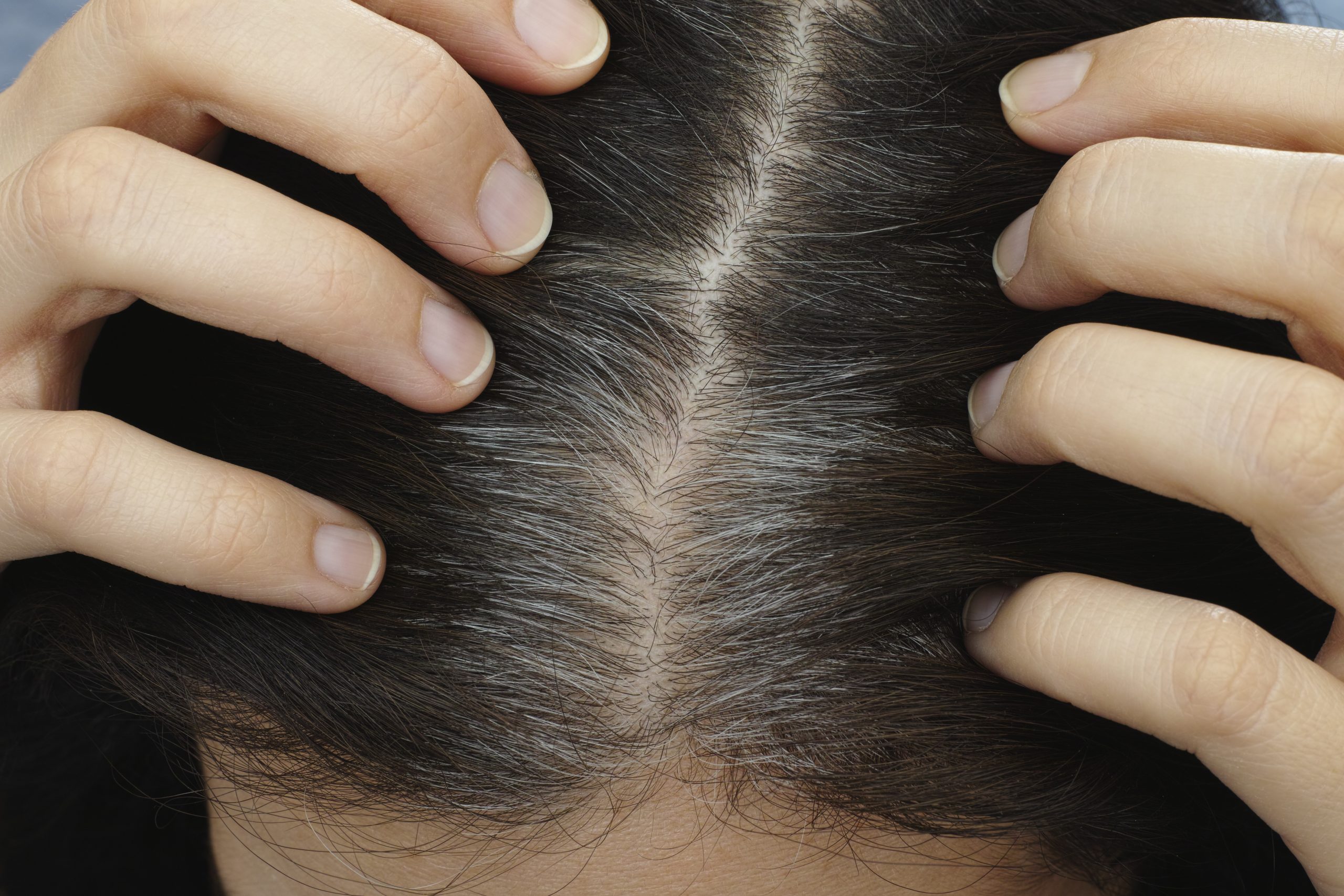 10 Home Remedies For Emerging Gray Hair