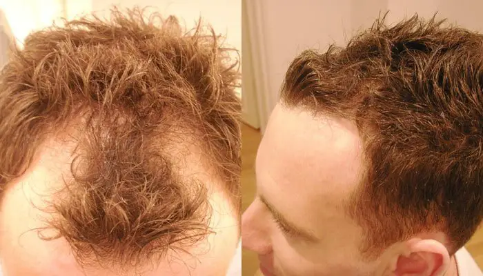 How To Stop Receding Hairline 