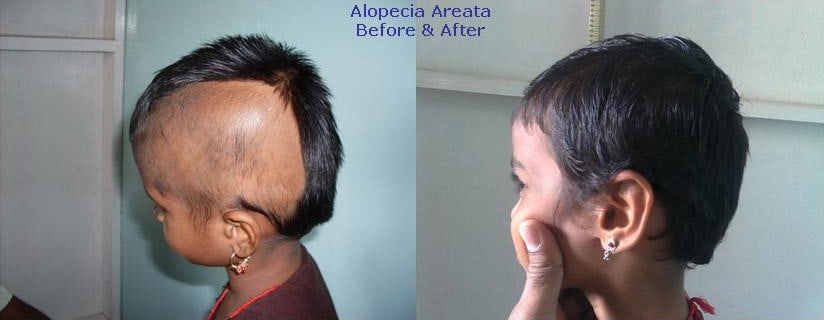 alopecia