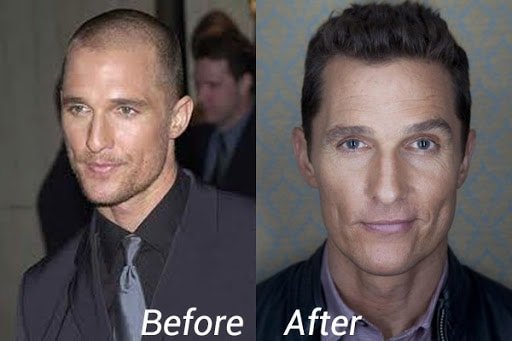 Matthew McConaughey hair transplant