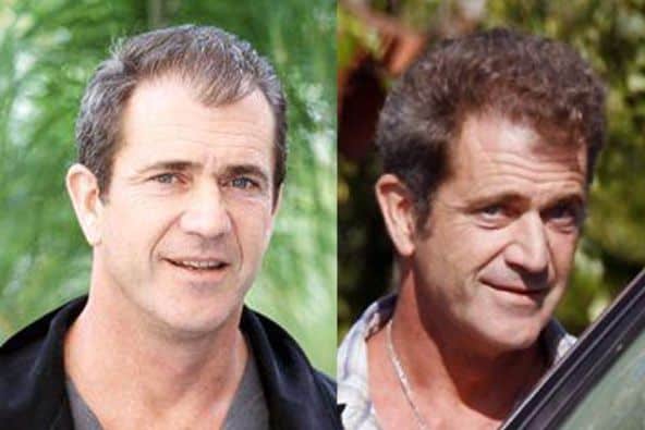 Mel Gibson hair transplant