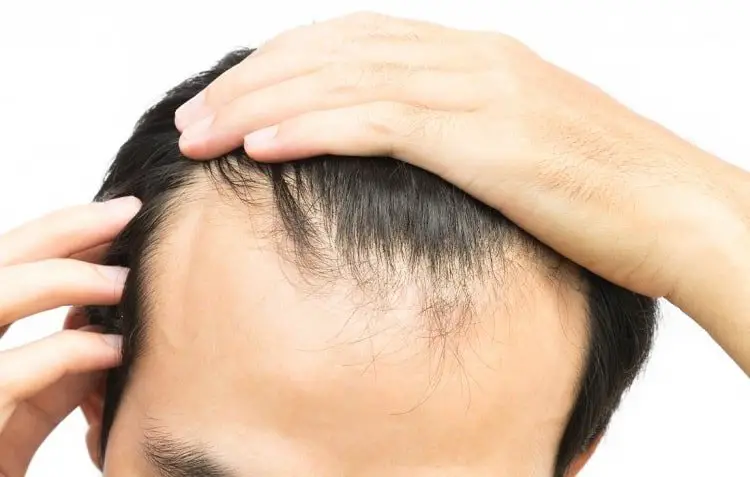 male-hairline-types-how-to-treat-it