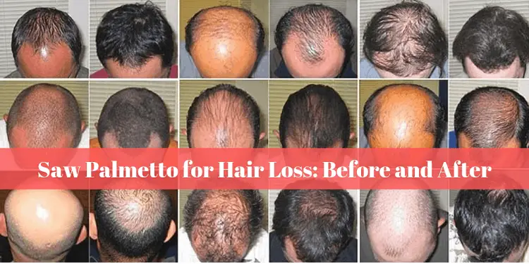 Saw Palmetto For Hair Loss Before And After How It Works