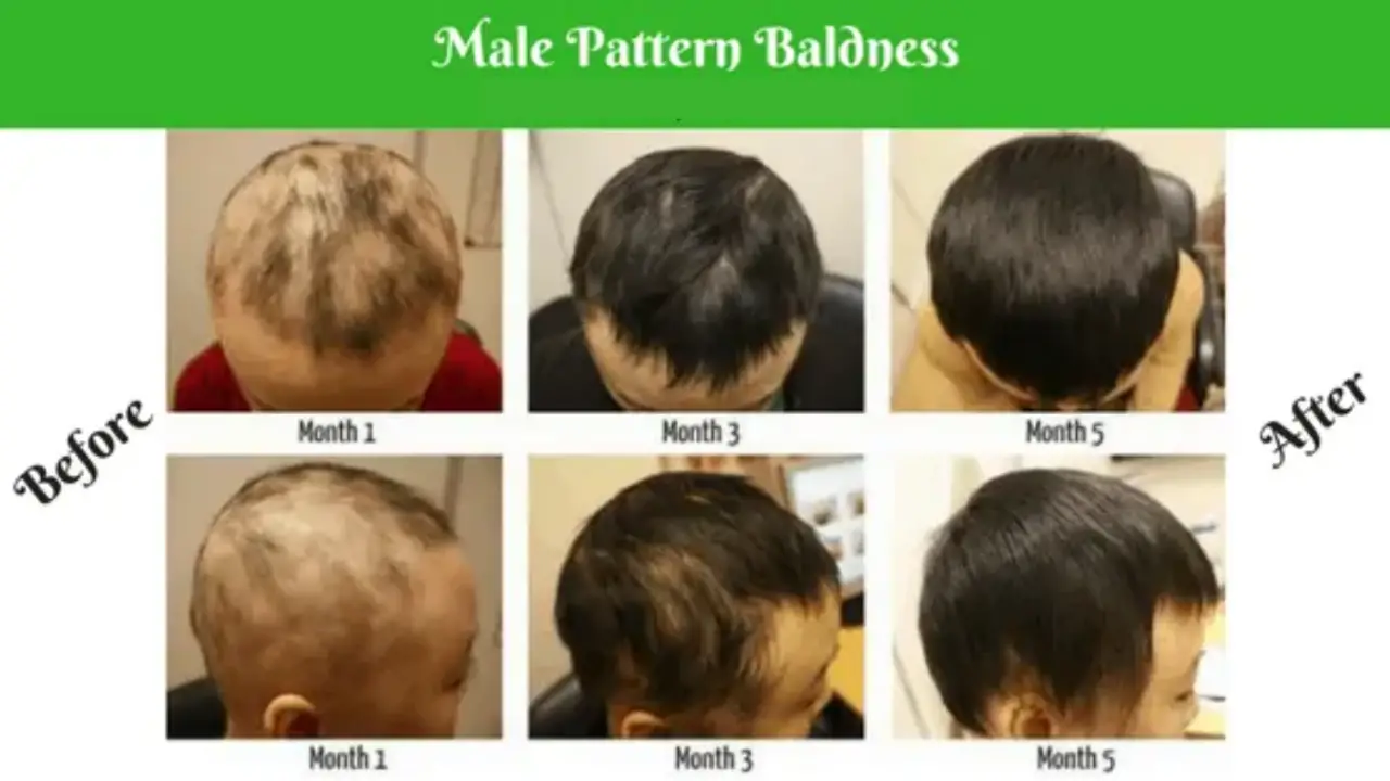 Patterns in Male Baldness