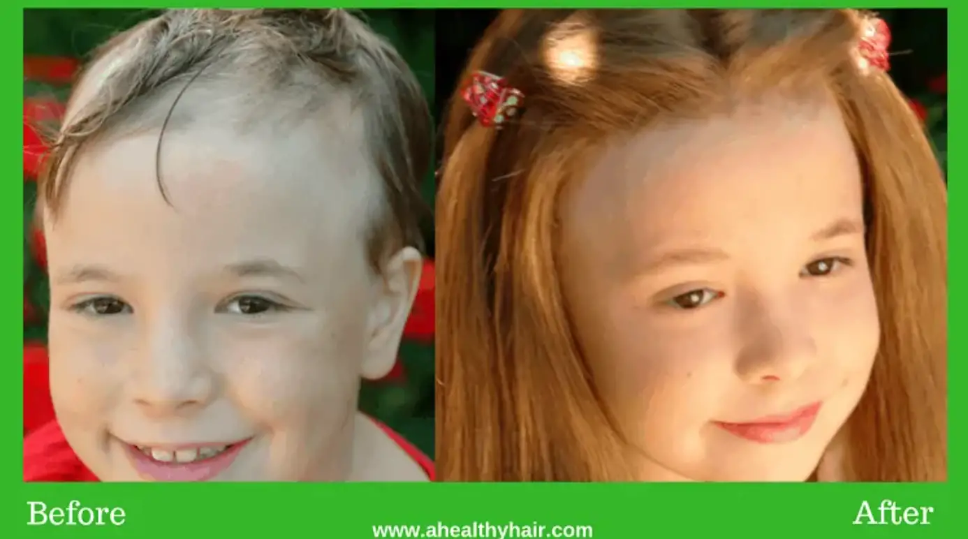 Children Hair Loss