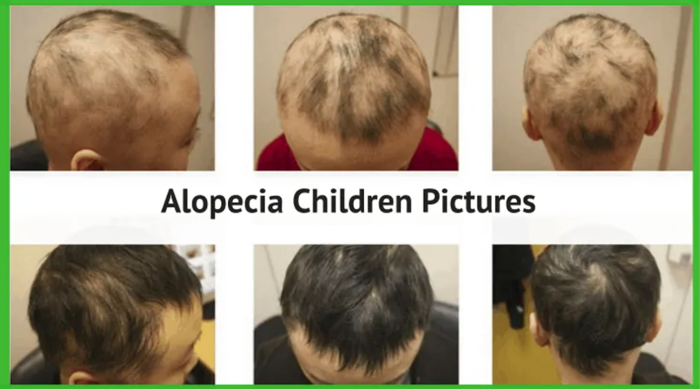 Child Alopecia