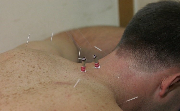 acupuncture for hair growth