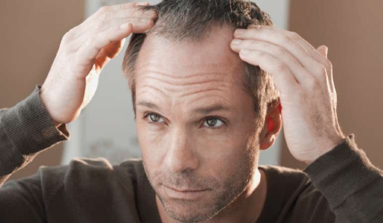 receding hairline for men