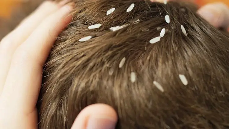 common causes of lice
