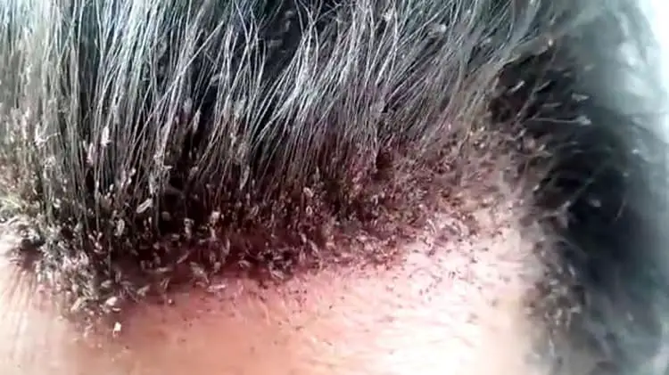 dry scalp vs. lice