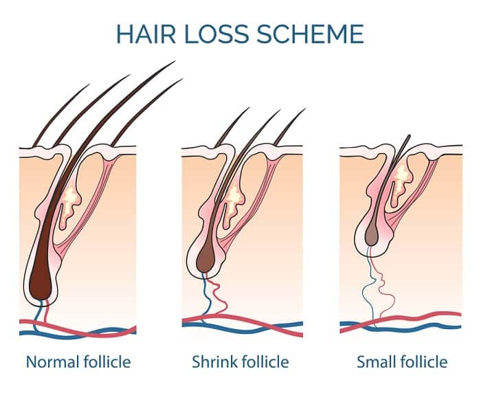 Hair loss scheme