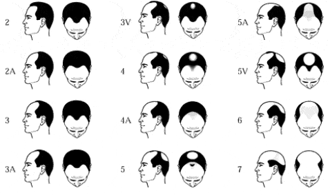 norwood_scale