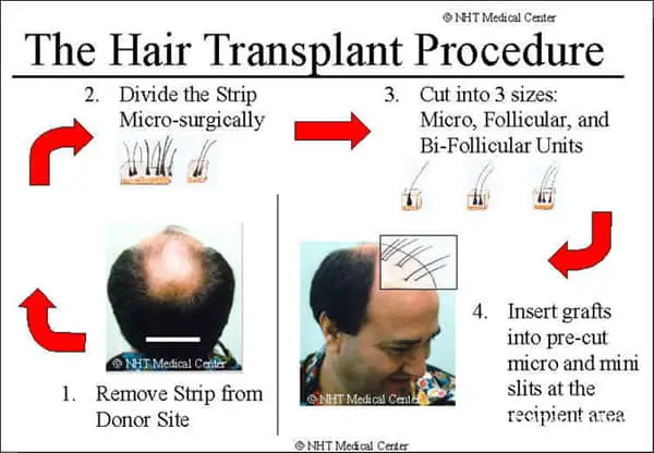 Hair Transplant and Regrowth for Men and Women