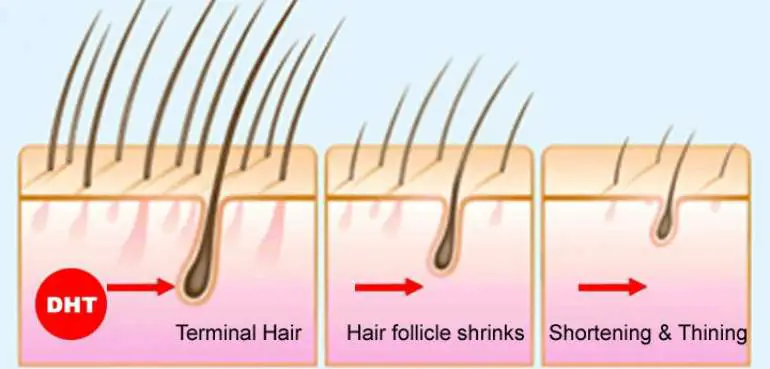 reasons for hair loss in men under 25