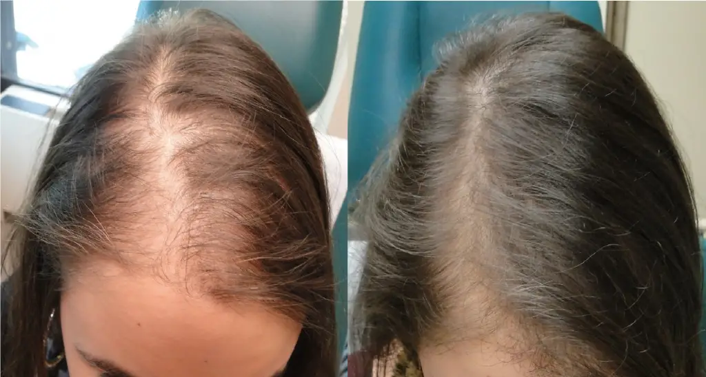 Ginger For Hair Loss Before And After Photos.