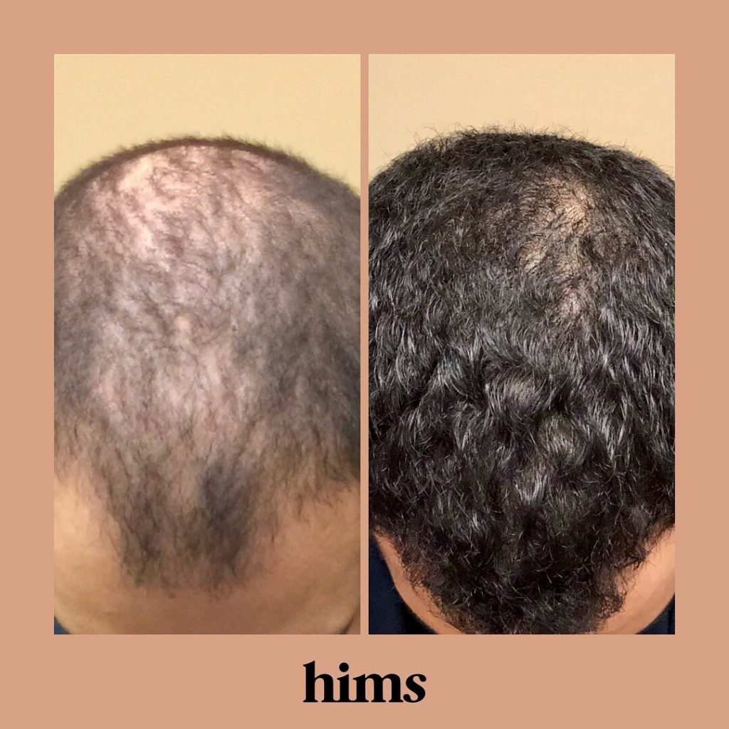 Hims vs Keeps: Which is Better for Hair Loss?