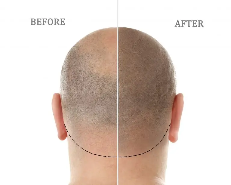 Scalp Micropigmentation: Is it Worth Doing?