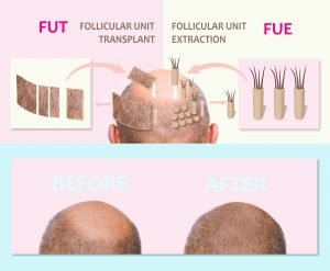 Hair Transplant Cost: How Much Do They Really Cost?