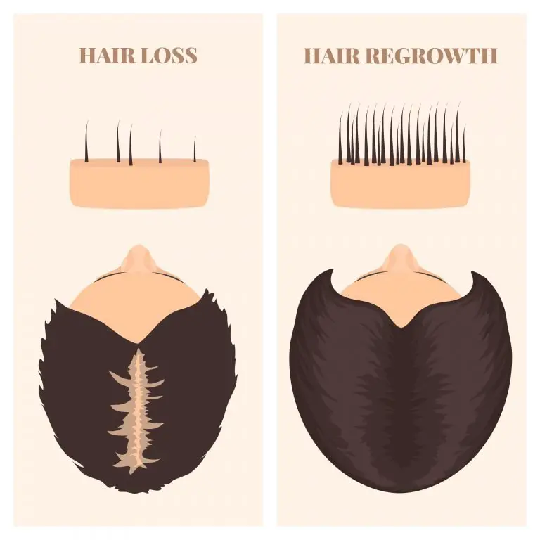 Can Hair Regrow After It Falls Out?