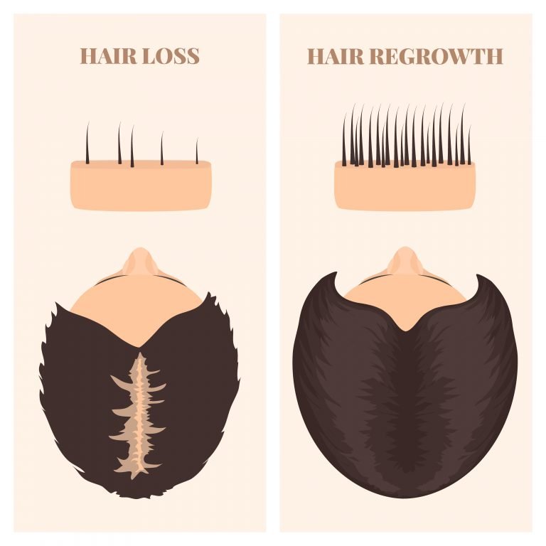 Can Hair Regrow After It Falls Out?