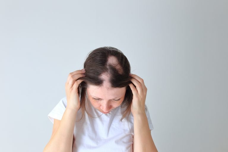 How To Stop Alopecia Areata From Spreading